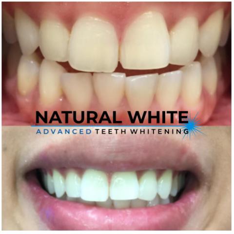 before and after teeth whitening, charlotte nc