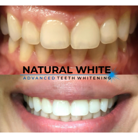 before and after teeth whitening, charlotte nc